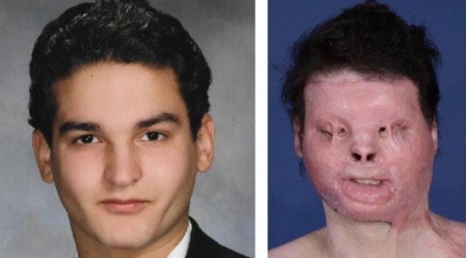 கை, முக மாற்று சிகிச்சை; இளைஞருக்கு மறுவாழ்வு